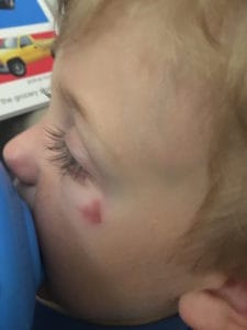 Blake Eye